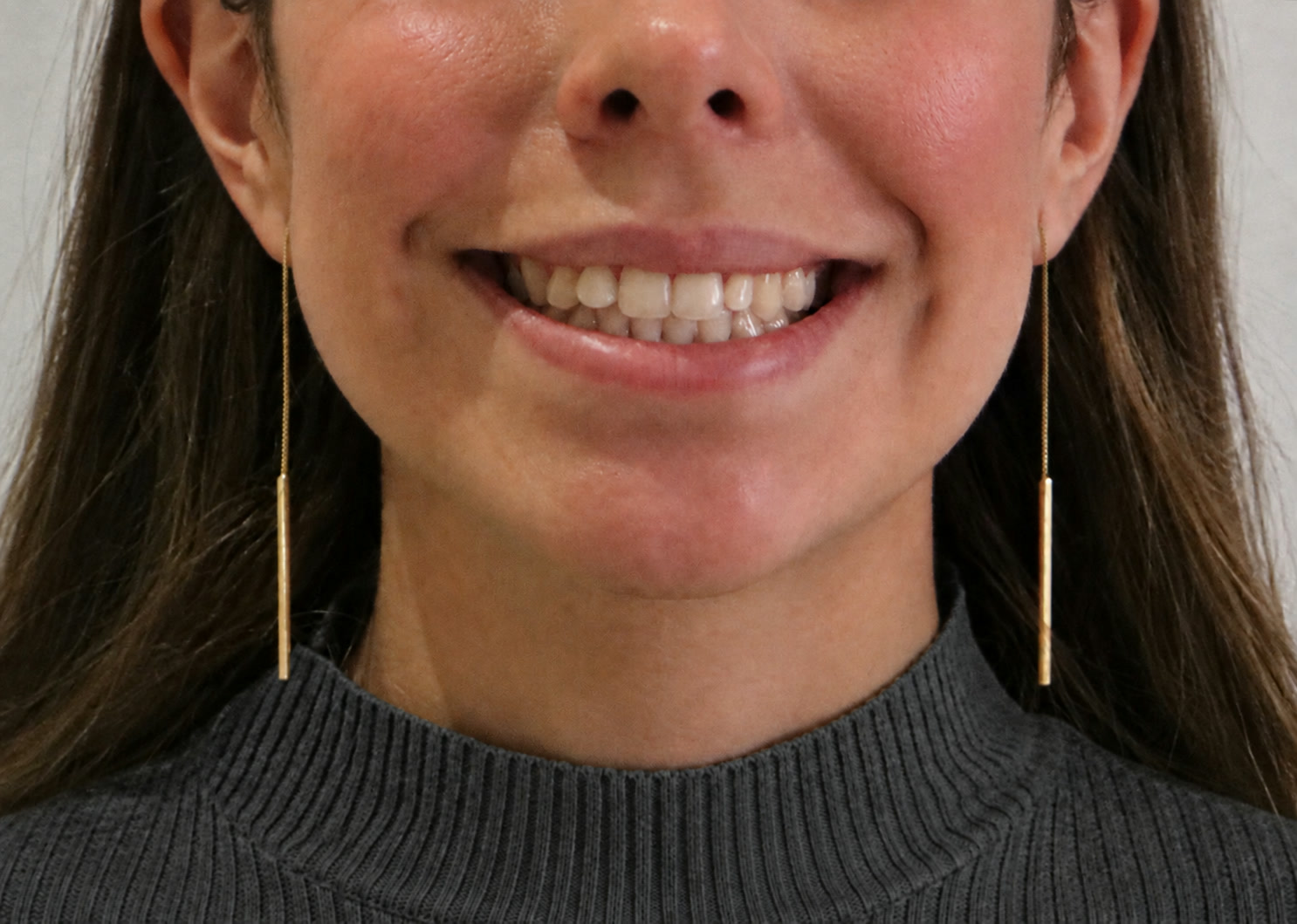 Después de tratamiento de sonrisa gingival, paciente de la Dra. Brenda López