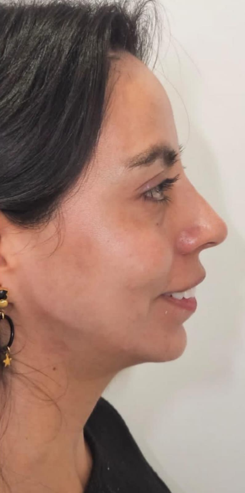 Después de rellenos de ácido hialurónico, paciente de la Dra. Brenda López