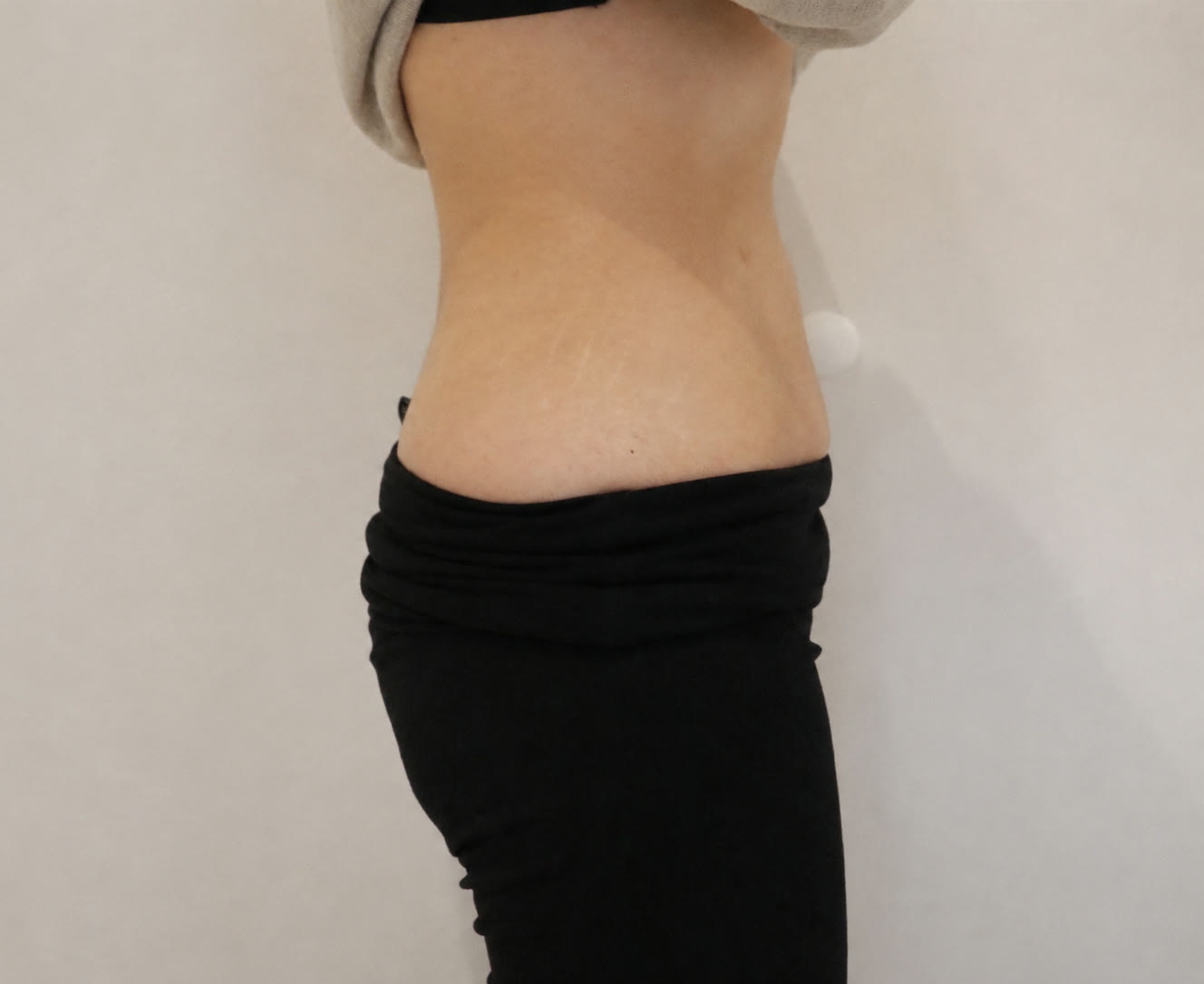 Antes de Endolyse en abdomen, paciente de la Dra. Brenda López